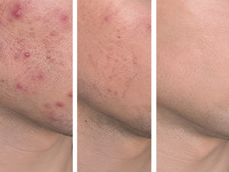 Acne Treatment Case