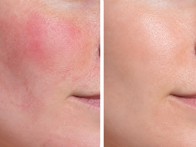 Post-Laser Treatment Recovery Case