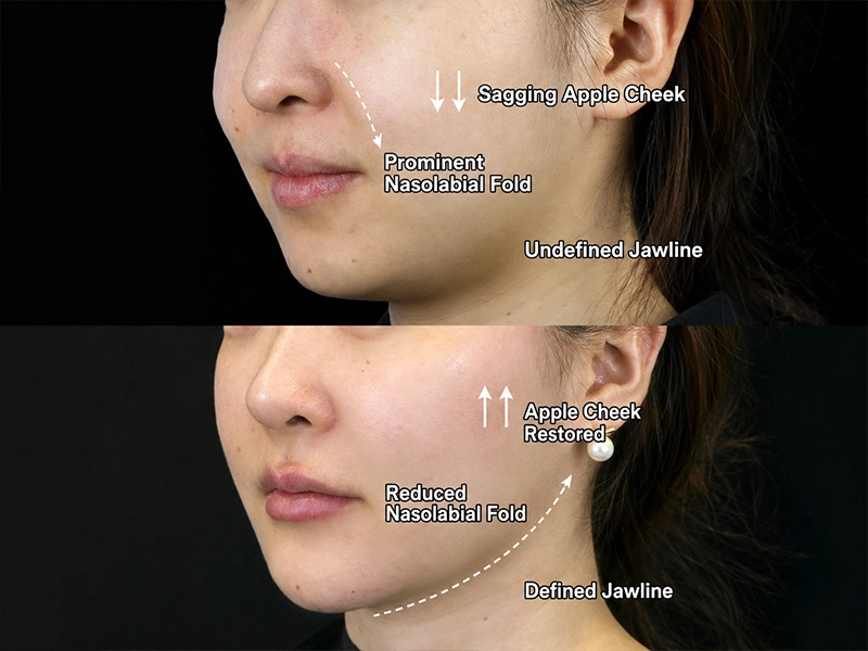 Skin Firming and Anti-Aging Case Study